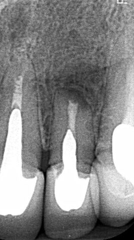 Endodontic treatment Success