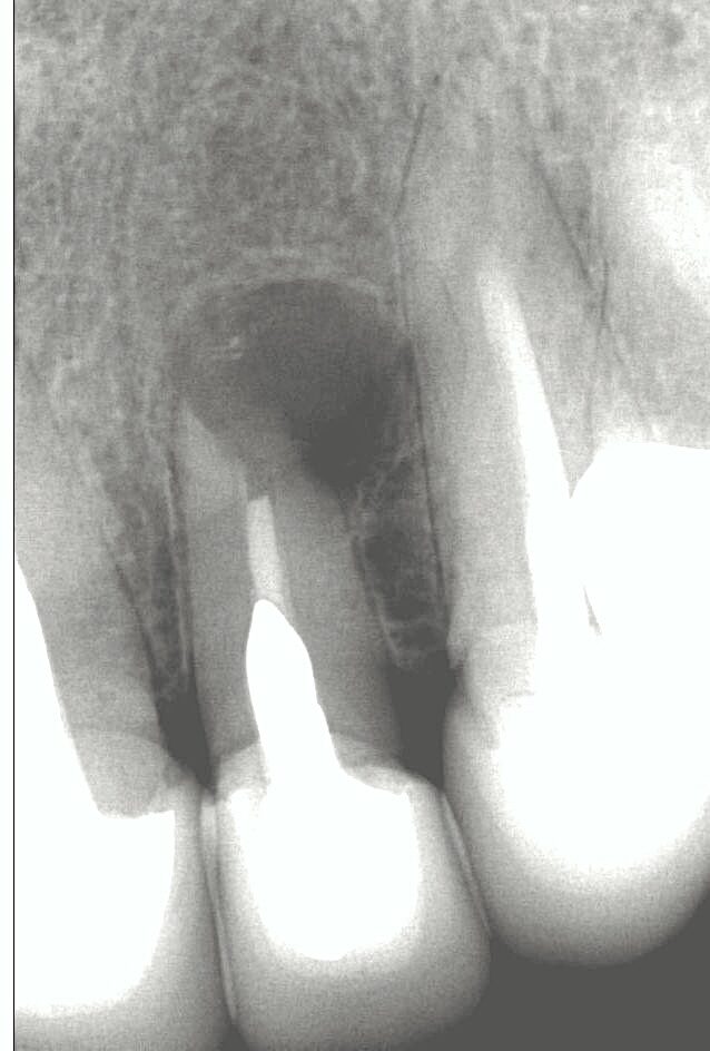 Root canal infection